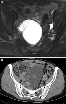 What is Mural Nodule in Ovarian Cyst: A Detailed Analysis